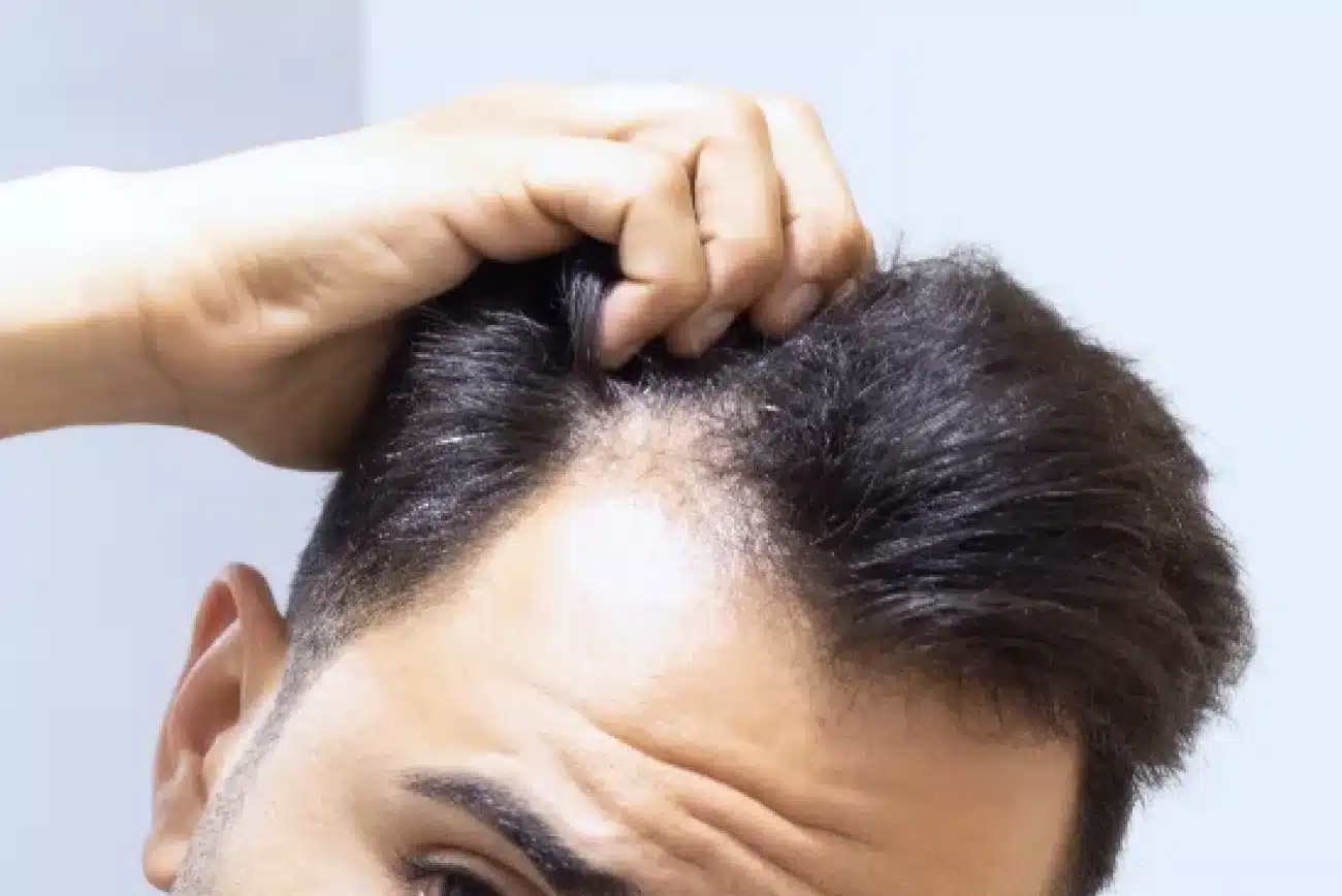 man with hair loss
